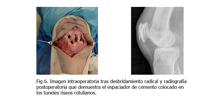 osteomielitis-somacot6