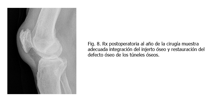 osteomielitis-somacot8