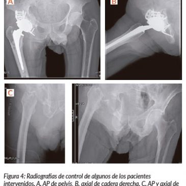 TRATAMIENTO DE LA FRACTURA – LUXACIÓN CENTRAL DE CADERA EN EL PACIENTE ANCIANO: NUESTRA EXPERIENCIA EN 5 AÑOS.*