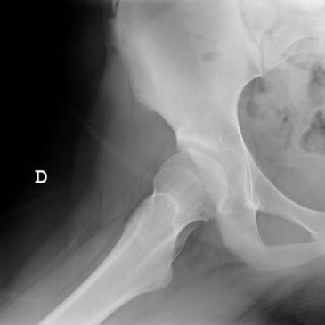 OSTEOTOMÍA PERIACETABULAR GANZ EN ADOLESCENTE