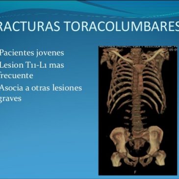 EVOLUCIÓN RADIOLÓGICA DE LAS FRACTURAS INESTABLES TORACO-LUMBARES SIN CLÍNICA NEUROLÓGICA TRATADAS MEDIANTE CIRUGÍA PERCUTÁNEA.