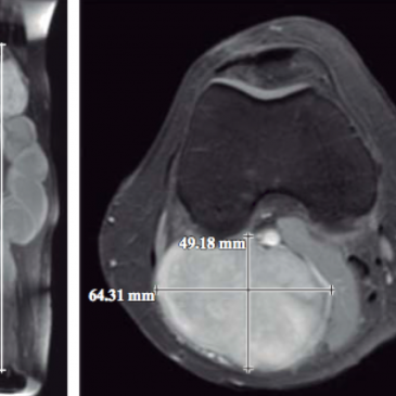 SCHWANNOMA GIGANTE DE NERVIO PERIFÉRICO SIN RELACIÓN CON LA NEUROFRIBROMATOSIS