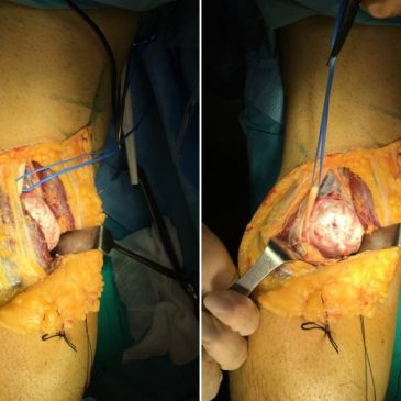 FRACTURA PATOLÓGICA SOBRE OSTEOCONDROMA QUE IMITA CLÍNICA E IMAGENOLOGICAMENTE A DEGENERACIÓN MALIGNA SECUNDARIA.